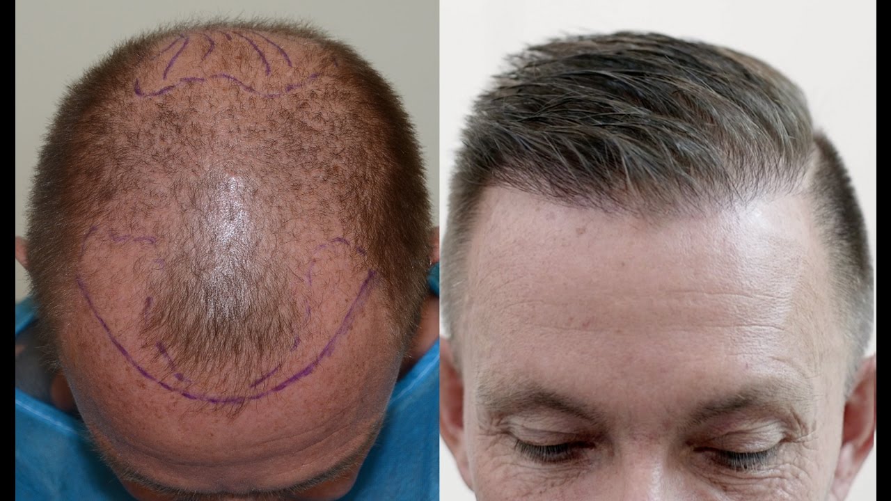 Hair Transplant Results Rated on Timeline Scale